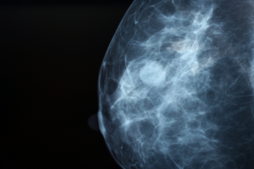 3-D Mammography Increase Cancer Detection Rates