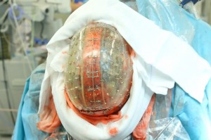 Surgeons successfully implant 3-D printed skull
