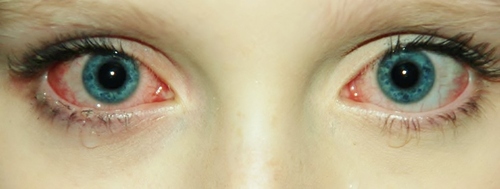 What Your Eye Color Says About How You Feel Pain