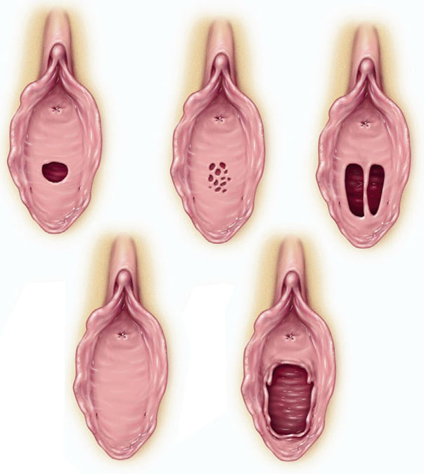 The Hymen: A Membrane Widely Misunderstood