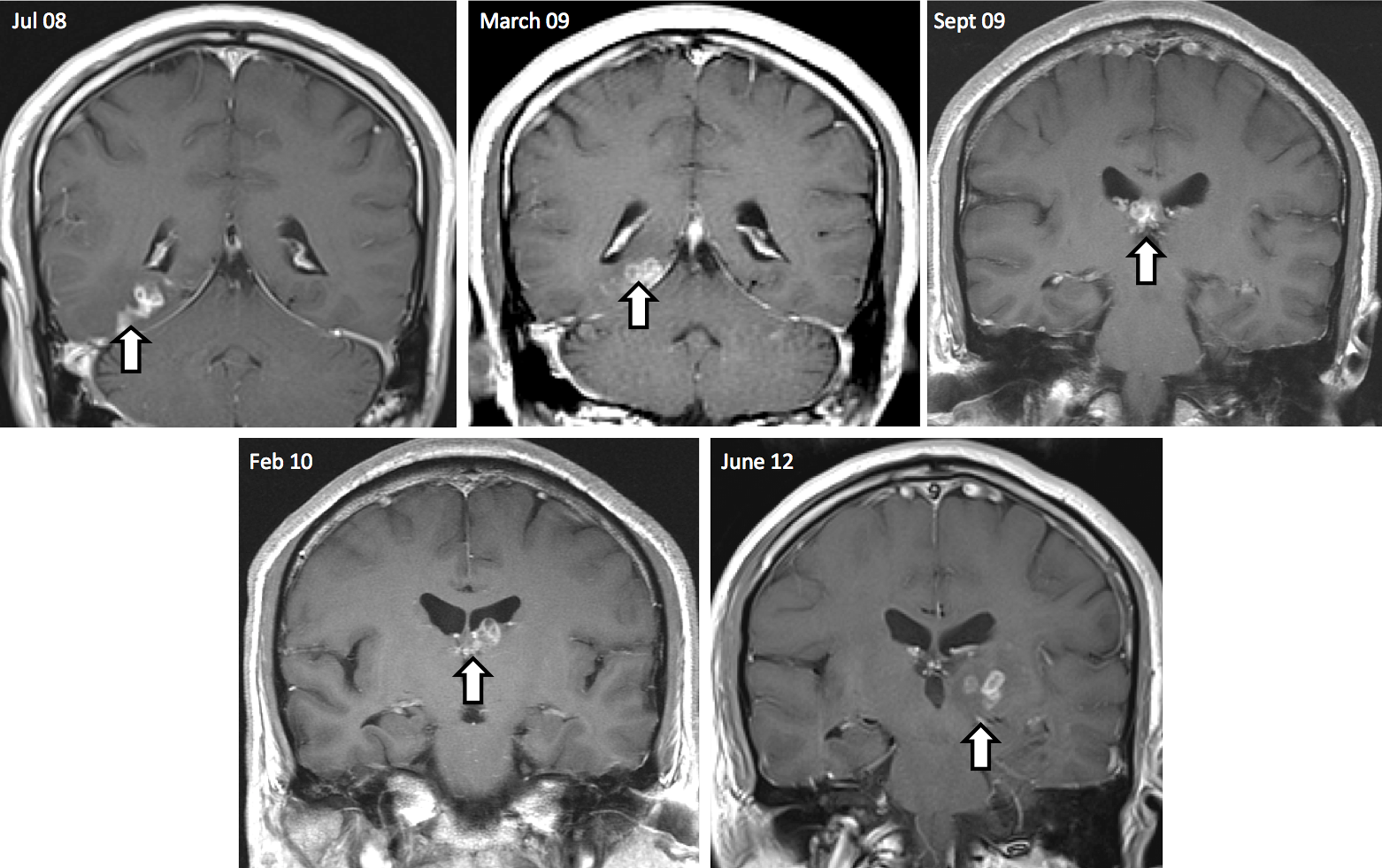 MRI scans reveal tapeworm in man's brain