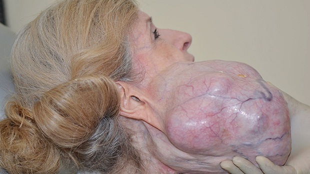 large-parotid