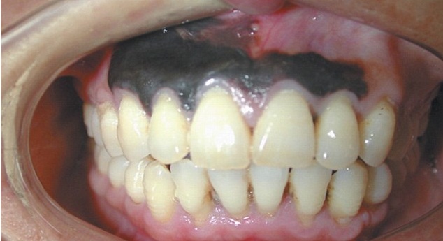 malenoma