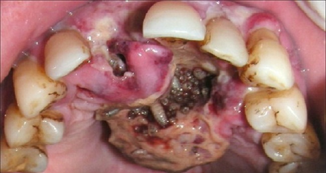 oral myiasis