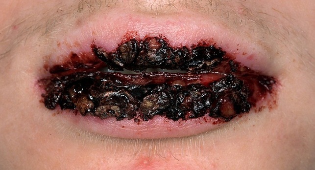 Erythema multiforme