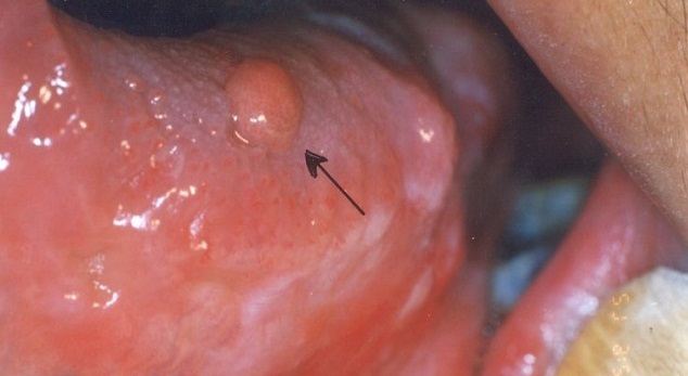 Folate papillae