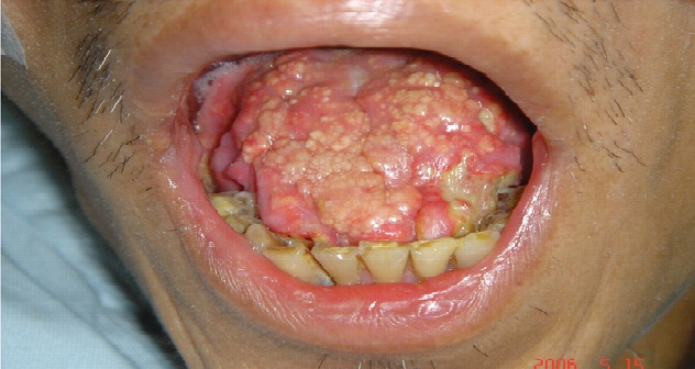 hemdia