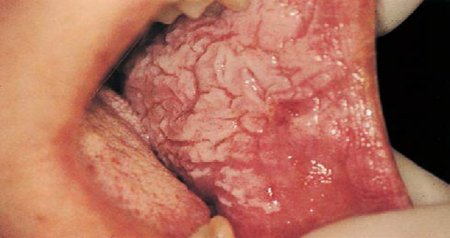 White sponge nevus