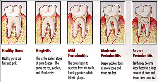 sstages periodontitis