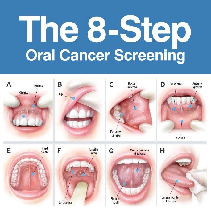 8-step-orgal-cancer-screening