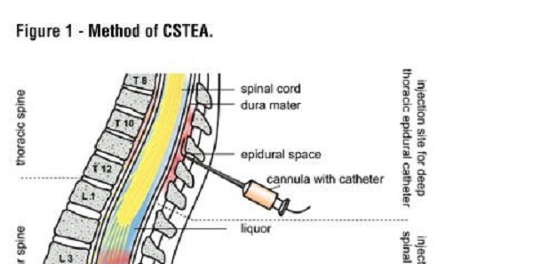 Method of CSTEA : Epidural vs spinal anesthesia - medicalkidunya