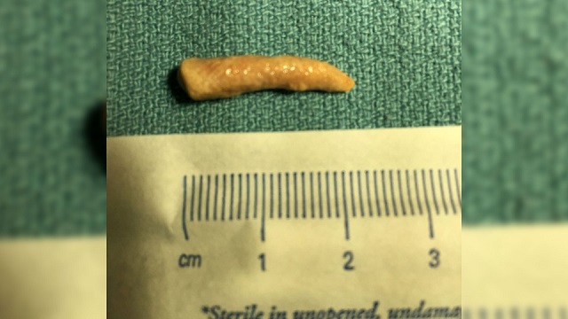 Putrid breath lands man in ER, doc discovers stone under tongue 1 sab