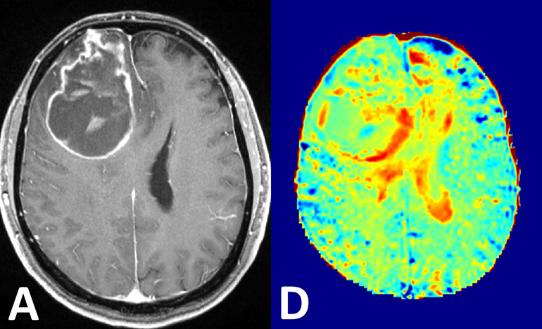 New MRI Technique Images Glucose in Body to Spot Tumors 1