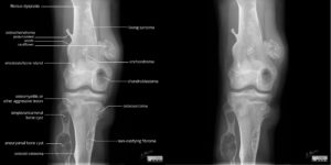 Benign and Malignant (age less than 30) Bone Lesions Illustration