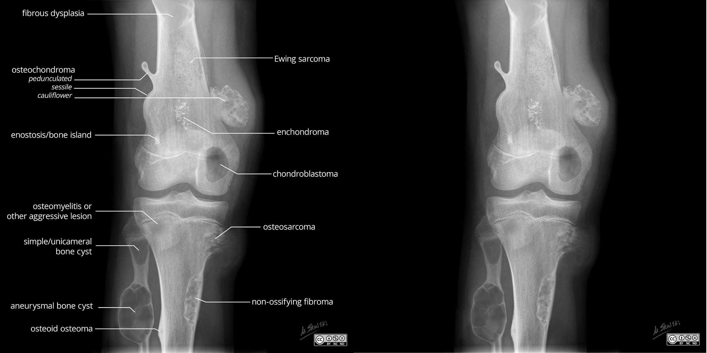 Benign and Malignant (age less than 30) Bone Lesions Illustration