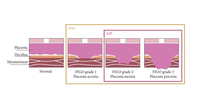 FIGO Grading Systems for Placenta Accreta Spectrum