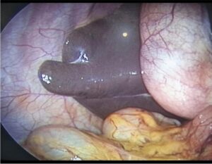 Riedel's Lobe of Liver