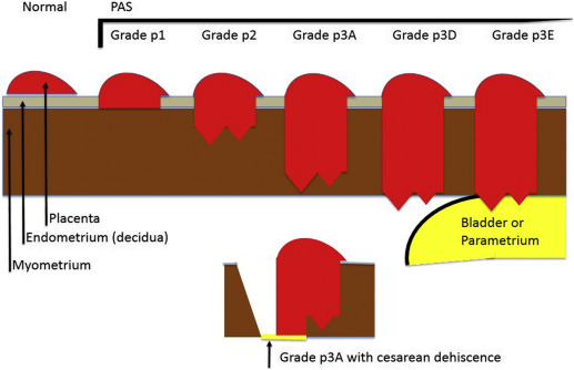 SPP Grading Systems for Placenta Accreta Spectrum